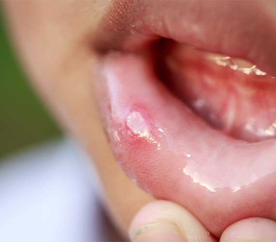粘膜病変（口内炎など）