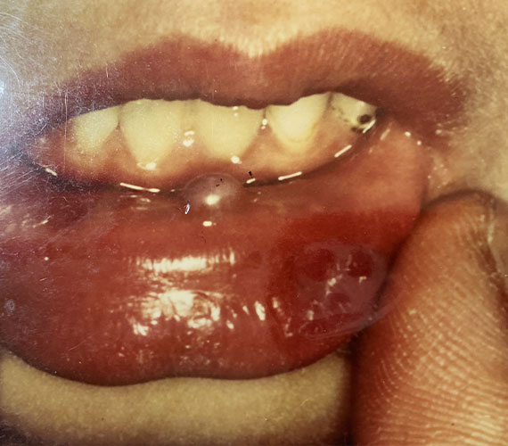 腫瘍・のう胞（できもの）