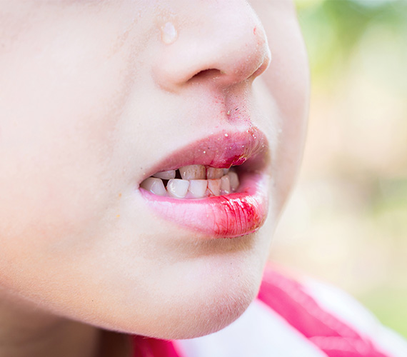 外傷（歯や唇、顎のケガ）