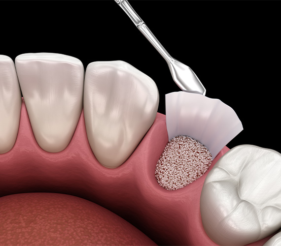 GBR法（骨誘導再生法）