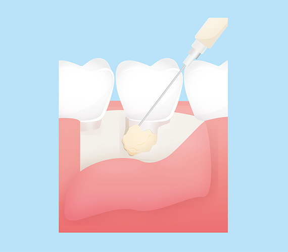 エムドゲイン法