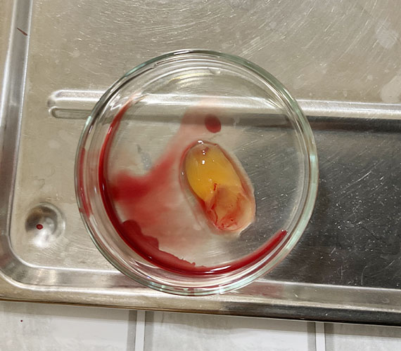 歯や歯ぐきの再生を助けるCGF療法