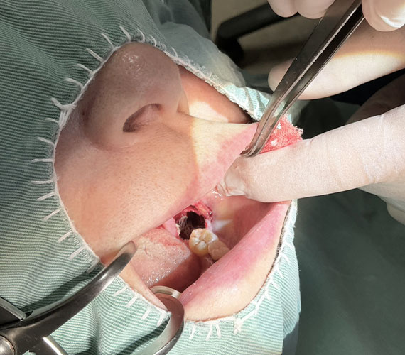 抜歯やのう胞摘出後の骨の再生