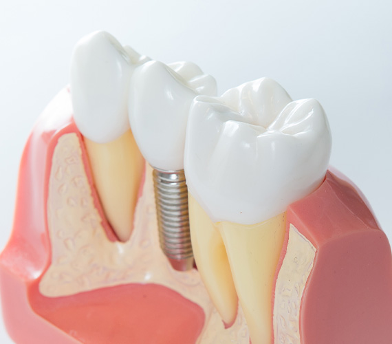 インプラント前の骨造成