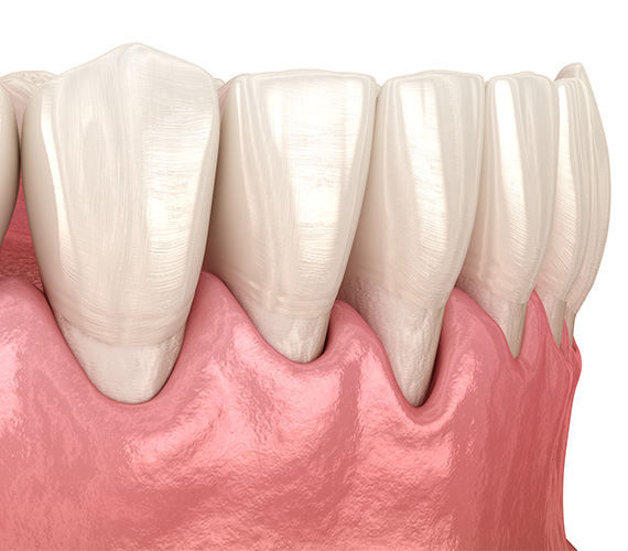 歯周外科治療後の骨再生