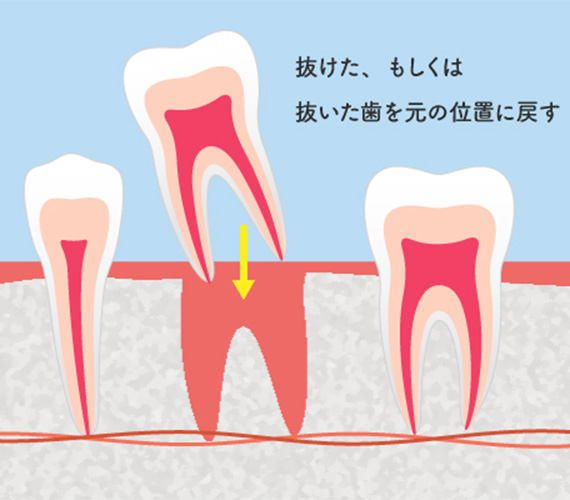 歯の再植