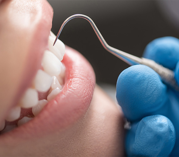 予防・クリーニング